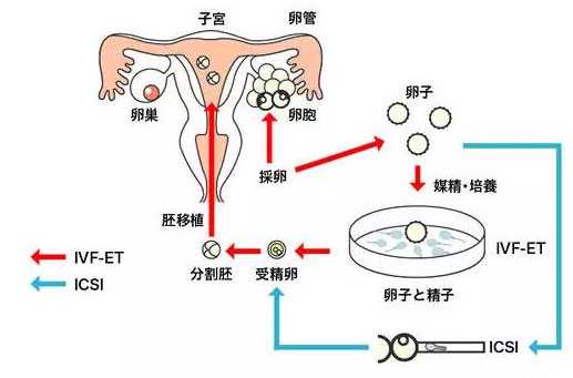 我国首例试管婴儿诞生三十余年纪念，详细步骤指南与历程回顾