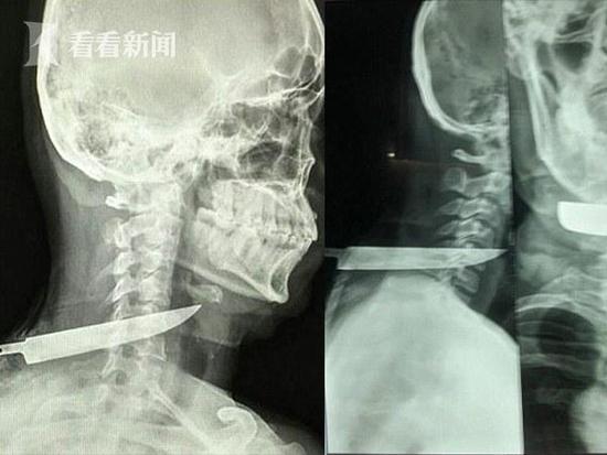 脊髓损伤最新突破