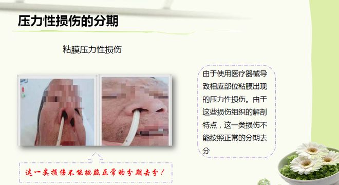 压疮最新分期与护理详解，小巷深处的护理瑰宝