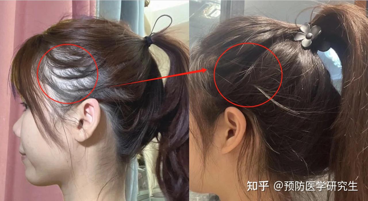 治愈脱发最新重大突破，秀发重现奇迹时刻的研究进展
