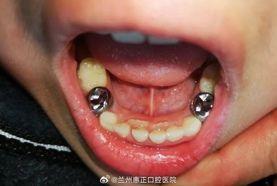 最新乳牙保髓方法，呵护宝宝口腔健康秘诀🌱
