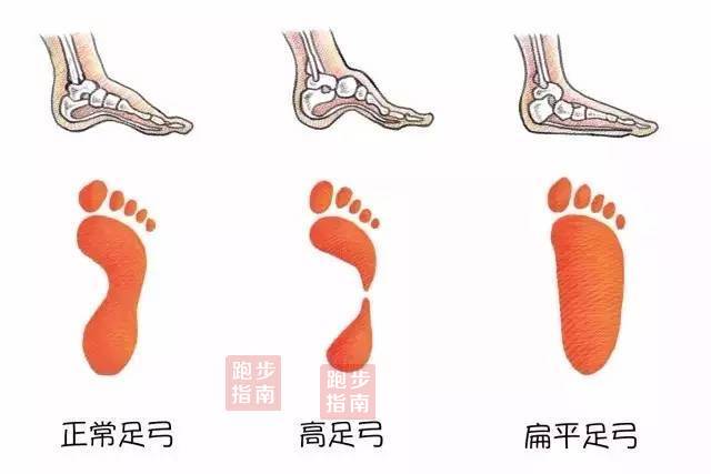 扁平足最新疗法揭秘，小巷深处的足弓治疗与隐藏小店探索